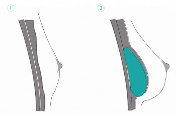 Brustvergrößerung Implantat unter dem Brustmuskel