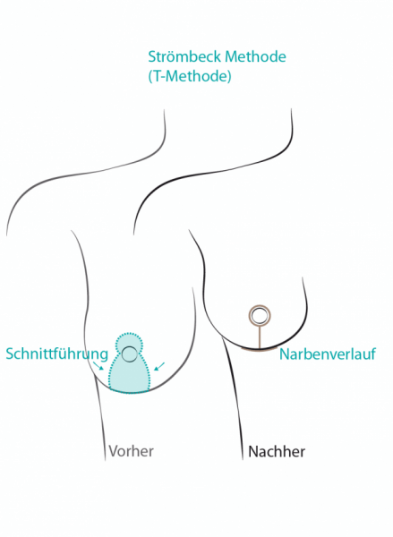 Strömbeck-Methode bei der Brustverkleinerung in der Esthetic am Kurfürstendamm